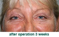 plastic-surgery-blepharoplasty